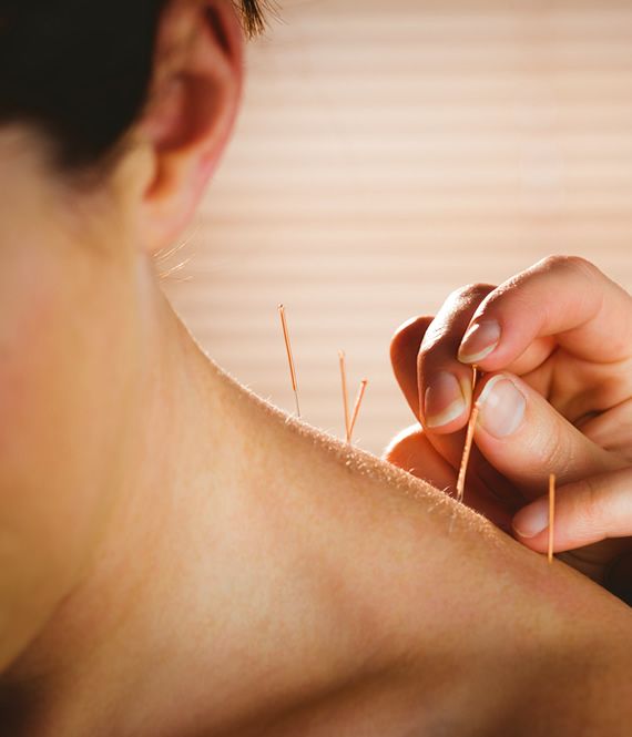 Dry Needling